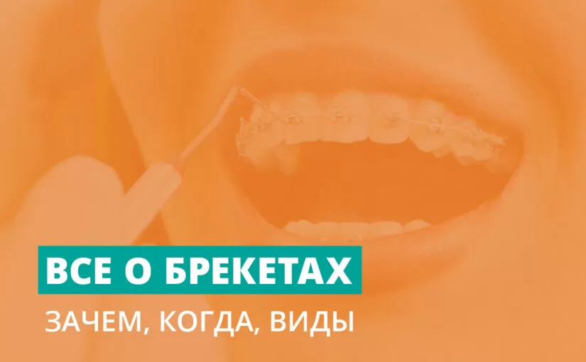Все о брекетах на зубах: зачем, когда, виды