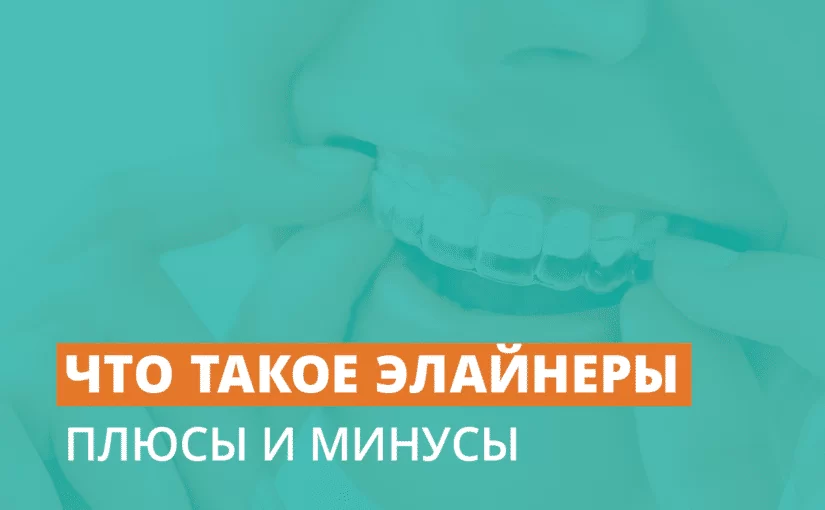 Что такое элайнеры: плюсы и минусы