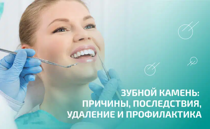 Зубной камень: причины, последствия, удаление и профилактика