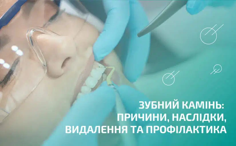 Зубний камінь: причини, наслідки, видалення та профілактика